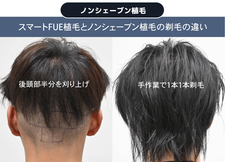 周りにバレたくない!という方にはノンシェーブン植毛がお勧めです。