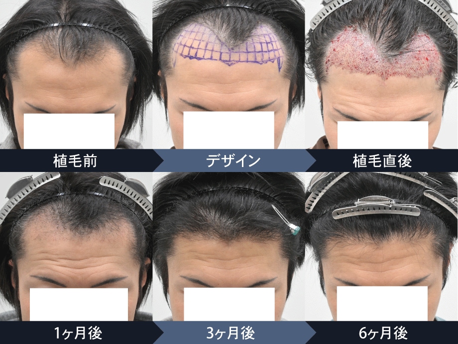 植毛の経過について