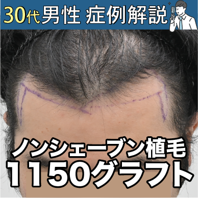 【症例紹介#01】M字も頭頂もどっちも生やしたい！