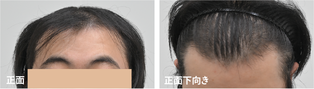 生え際の進行