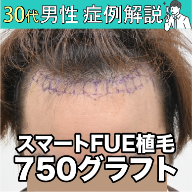 【症例紹介#02】ミノキ20mg飲んでも生え際がぱやぱやのまま…