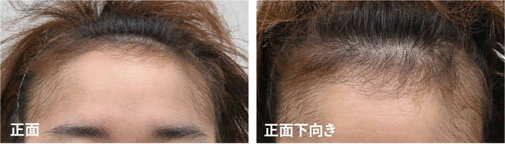 生え際の進行