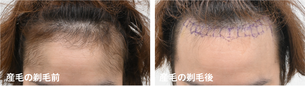 今回の植毛で工夫した点はありますか？