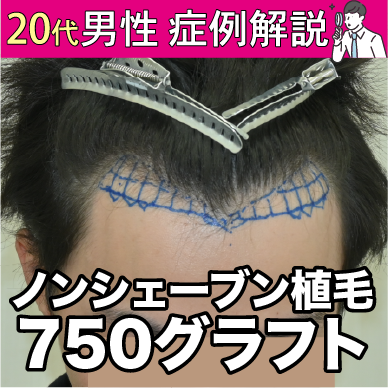 【症例紹介#03】20代で初めての薄毛治療が植毛