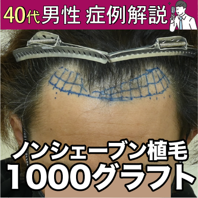 【症例紹介#04】特殊な生え際の自毛植毛