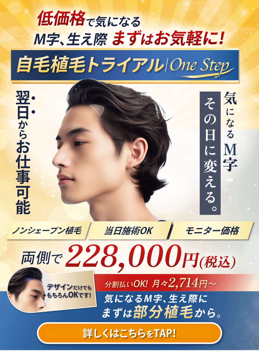 “自毛植毛モニター募集”