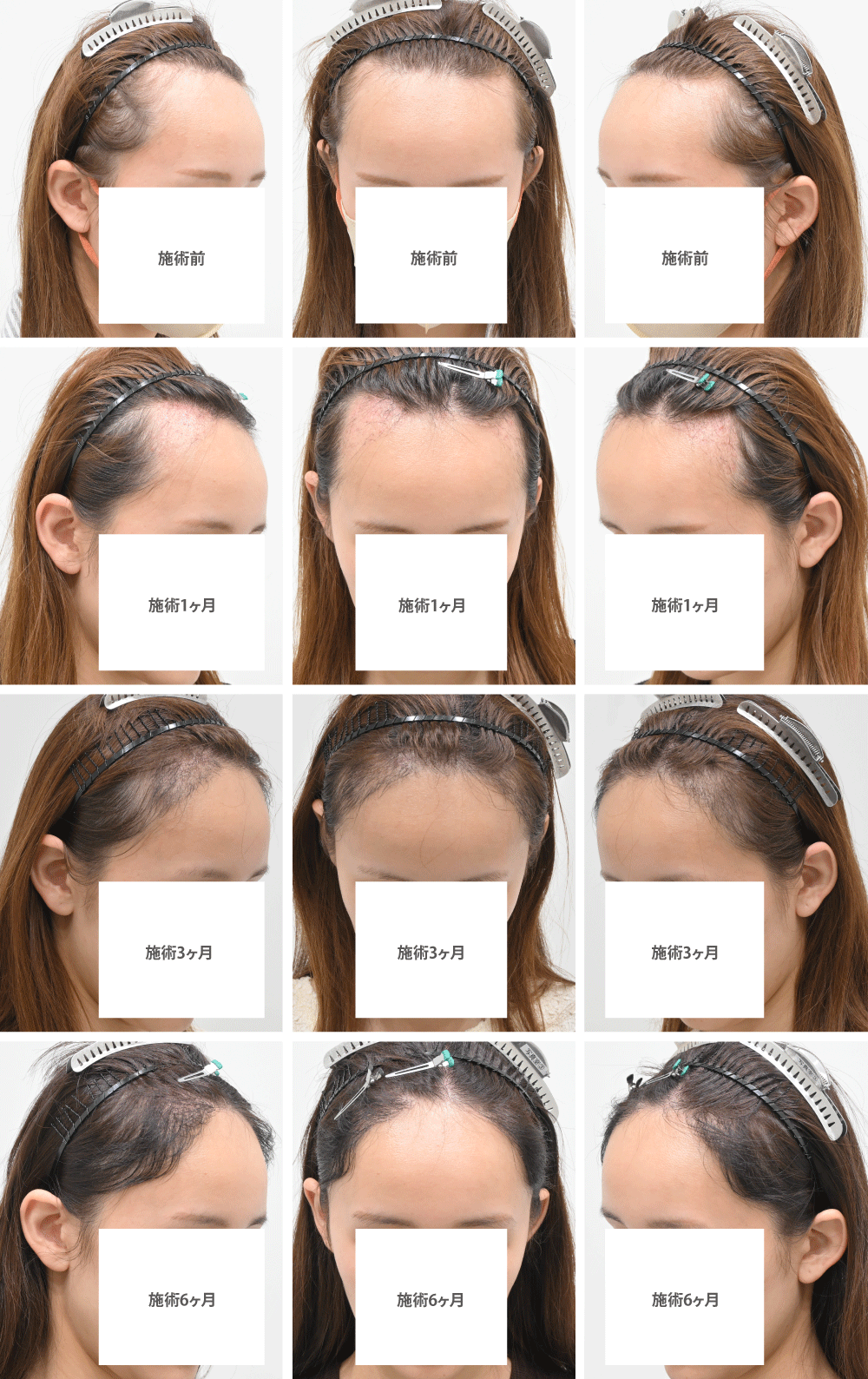 それでは、気になる術後の経過を見ていきましょう