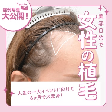女性のヘアライン植毛で額を狭く！小顔効果にも