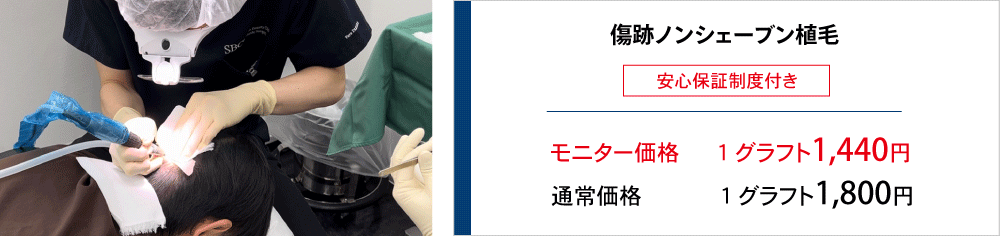 ノンシェー分植毛