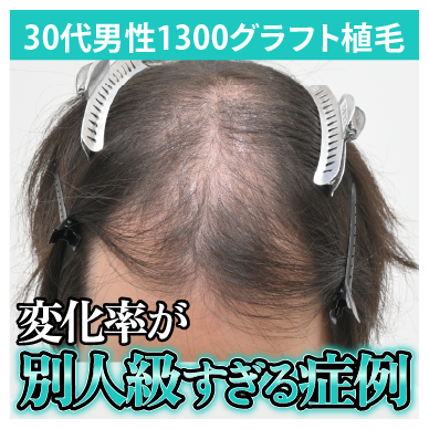 重度AGAから別人のような髪型へ導いた複合治療