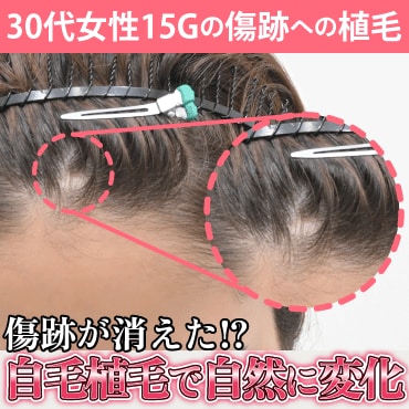 諦めていた傷跡から髪が生える？傷跡植毛でコンプレックスを解消