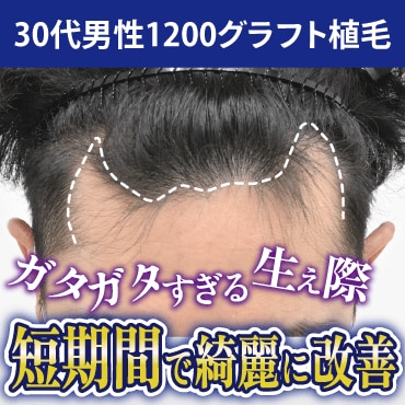 【症例紹介】生え際の左右差を整える自毛植毛
