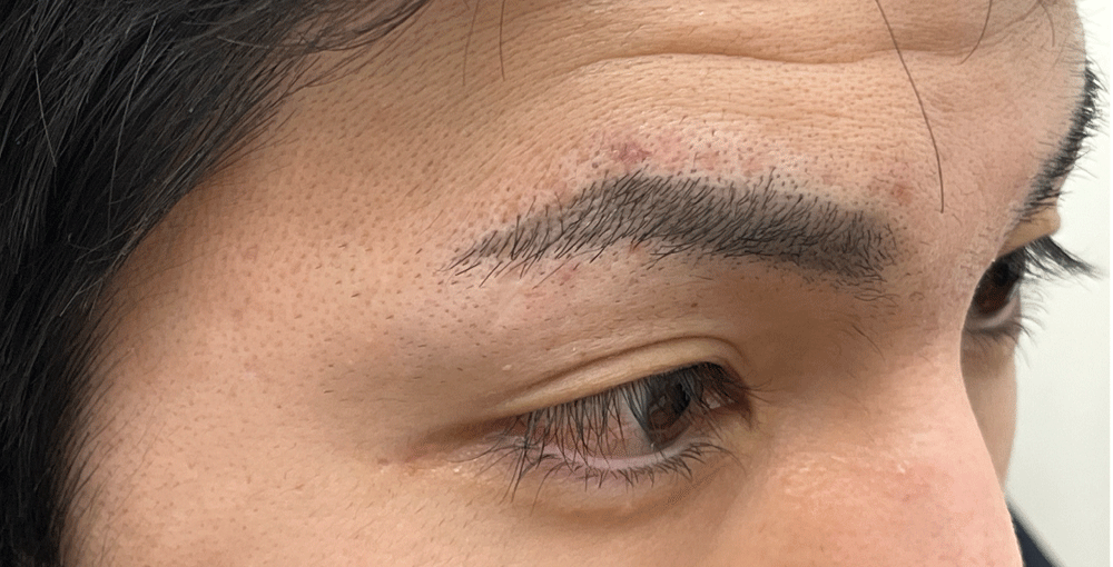 施術後の「赤み」や「腫れ」はありましたか？