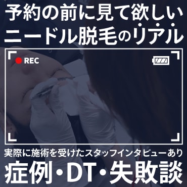札幌でヒゲ・白髪のニードル脱毛なら湘南AGA札幌院