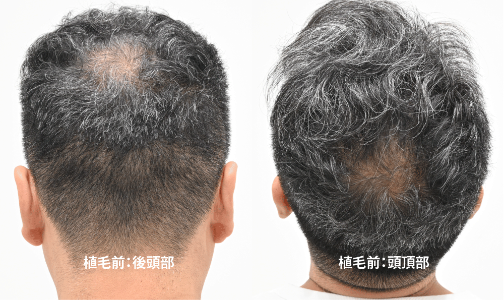 治療歴： AGA内服薬を約10年間継続