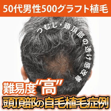 内服の限界を超えろ!頭頂部自毛植毛の症例