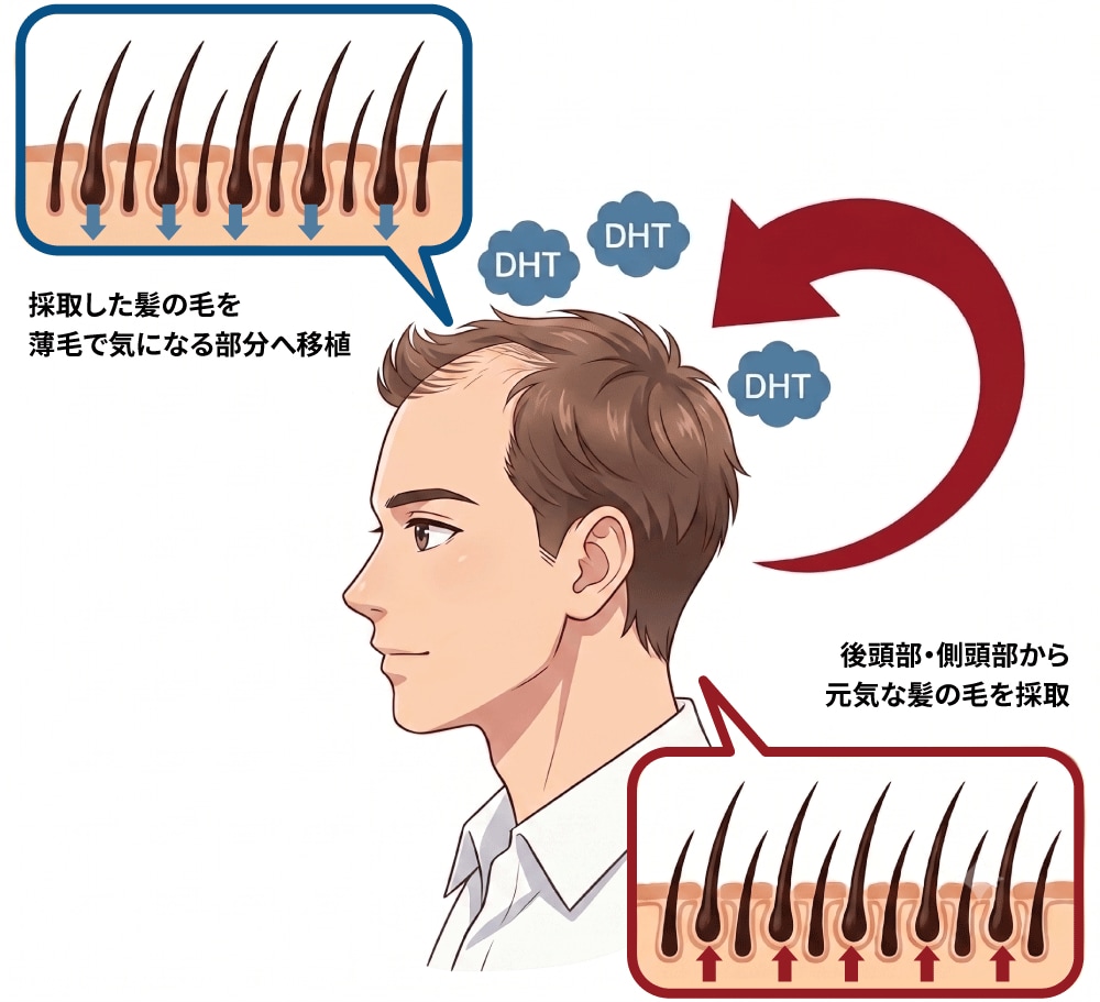 湘南独自の自毛植毛の仕組み