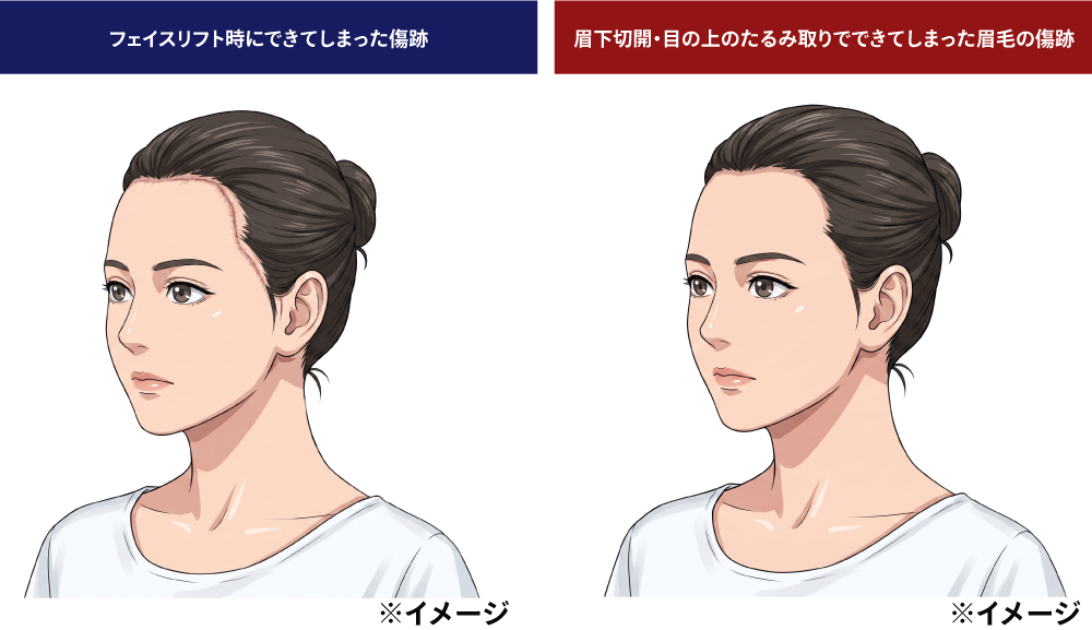 圧迫バンドによる傷跡だけでなく、植毛の技術は様々な傷跡の修正に応用できます