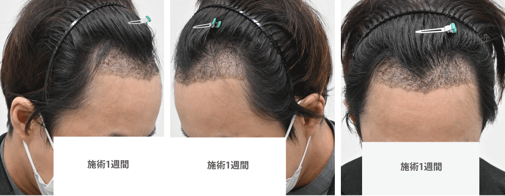 術後1週間:定着率を高める重要な期間