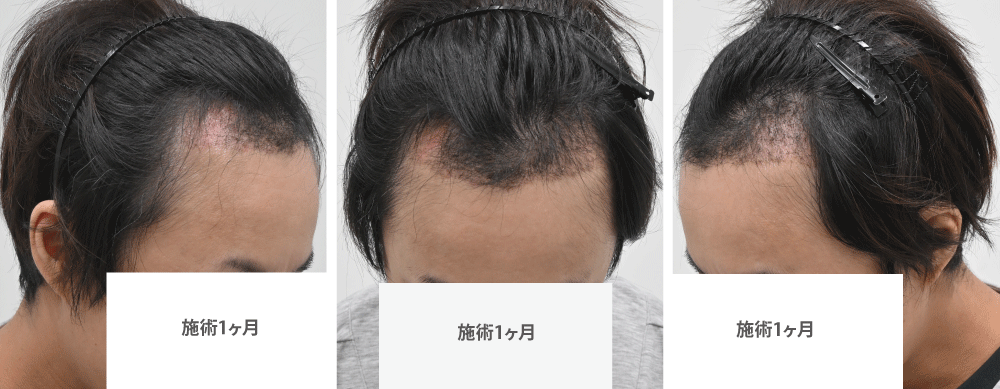 術後1ヶ月:一時的な抜け毛の時期(脱落期)