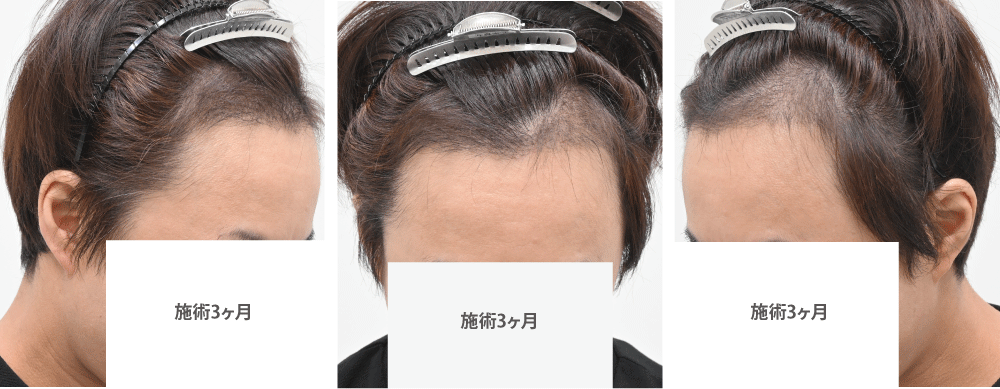 術後3ヶ月:発毛の実感