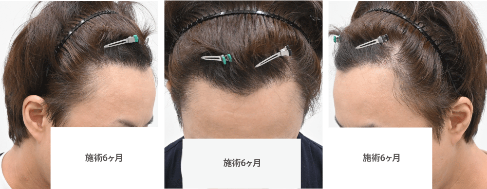 術後6ヶ月:自然なヘアライン