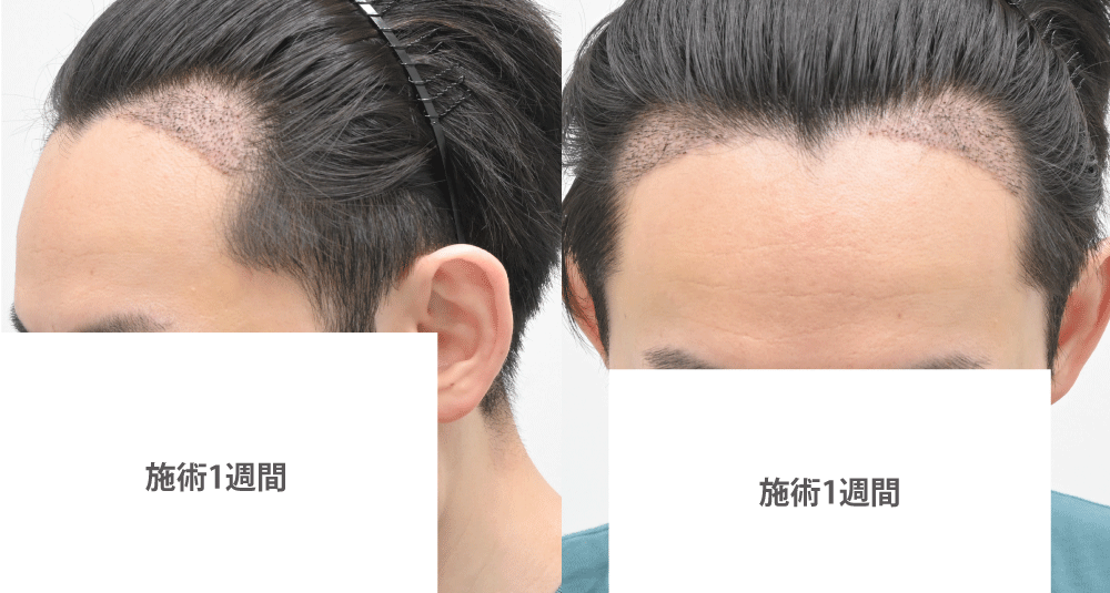 術後1週間