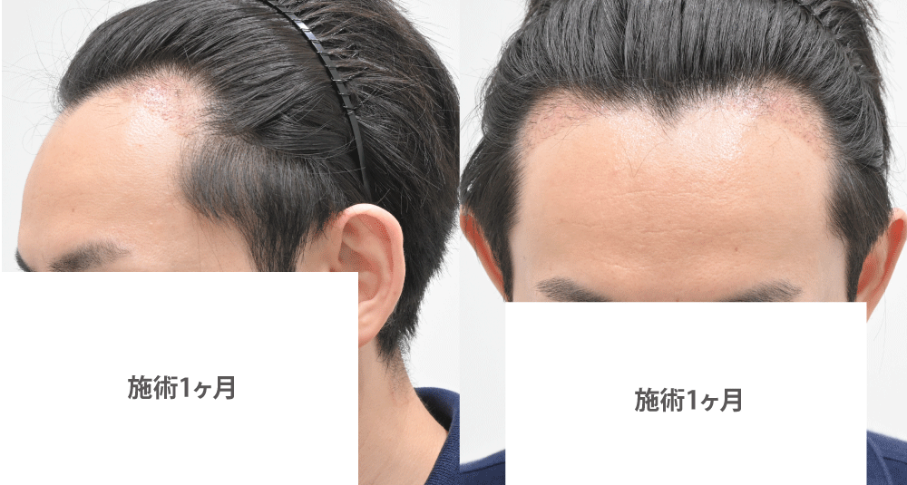 術後1ヶ月