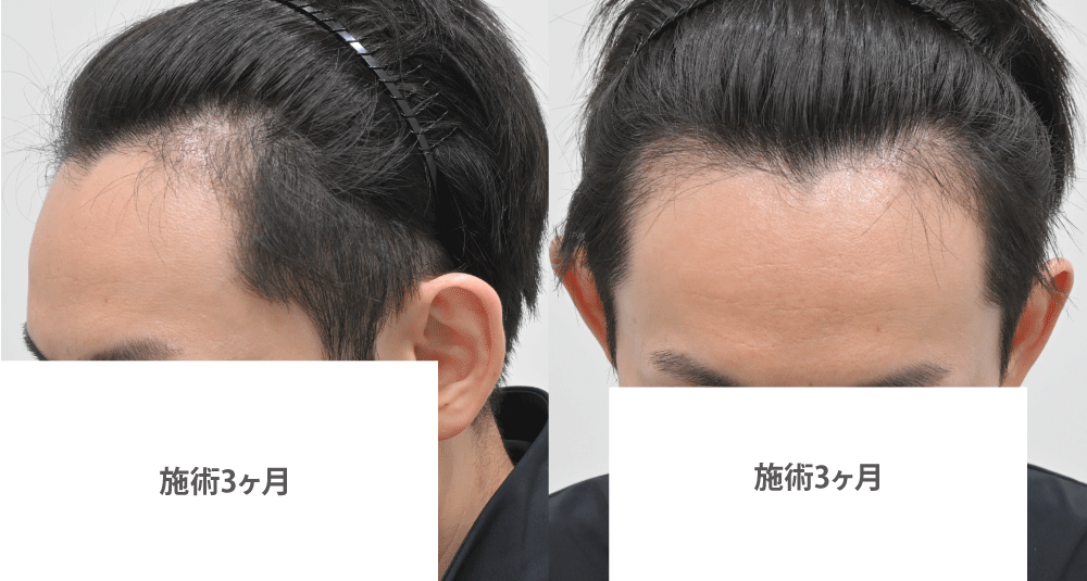 術後3ヶ月