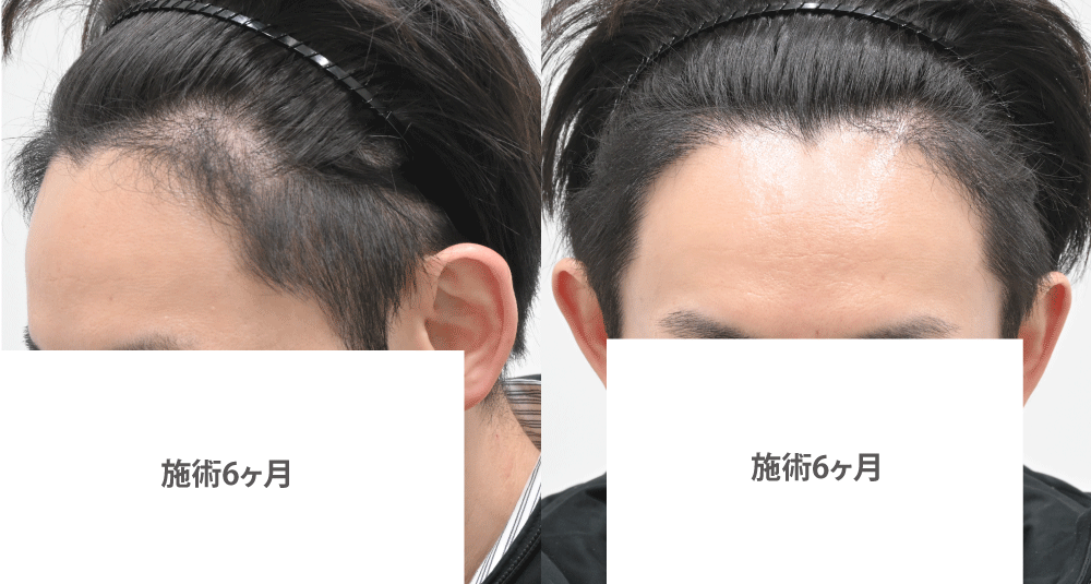 術後6ヶ月
