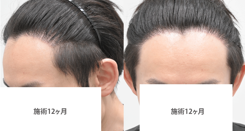 術後12ヶ月