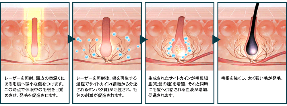 フォリックス発毛レーザーキャンペーン開始