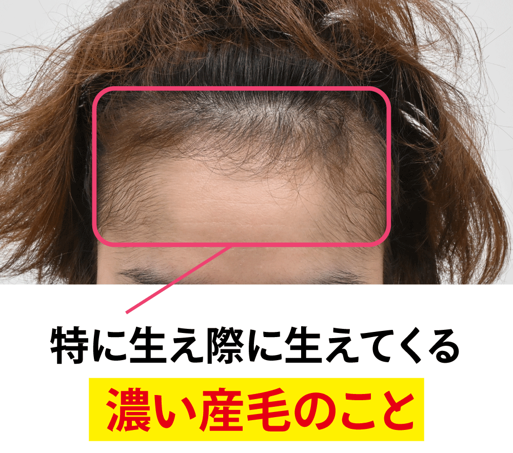薬を飲んでもフサフサにならない？「ミノキ毛」の限界