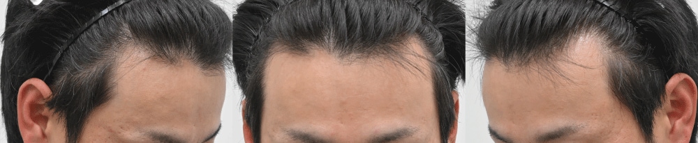 今回の症例モニター様のお悩みとご希望