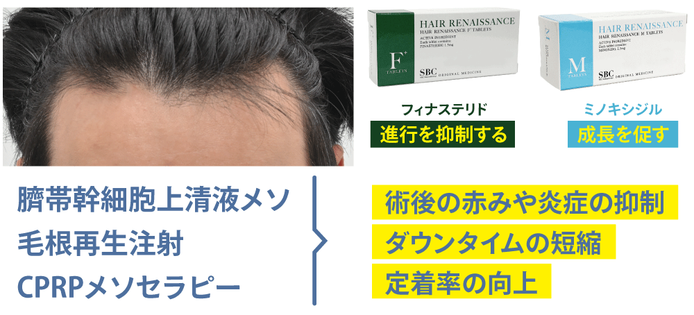 内服薬と再生治療の組み合わせ