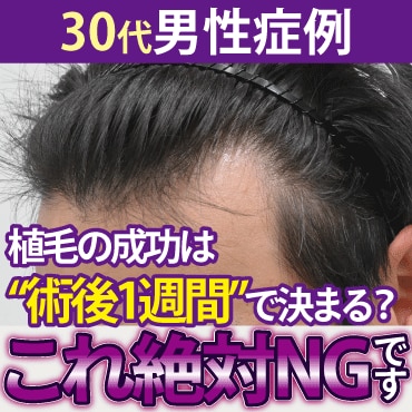 植毛成功の鍵は「術後1週間の過ごし方」にあり