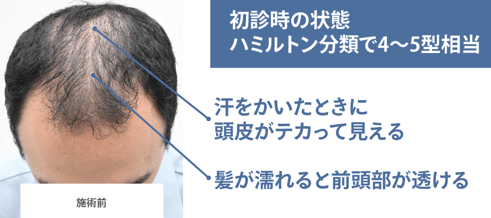 今回ご紹介するのは、20代前半でご来院されたモニター様です