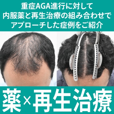 20代重症AGA：薬と再生治療の改善例