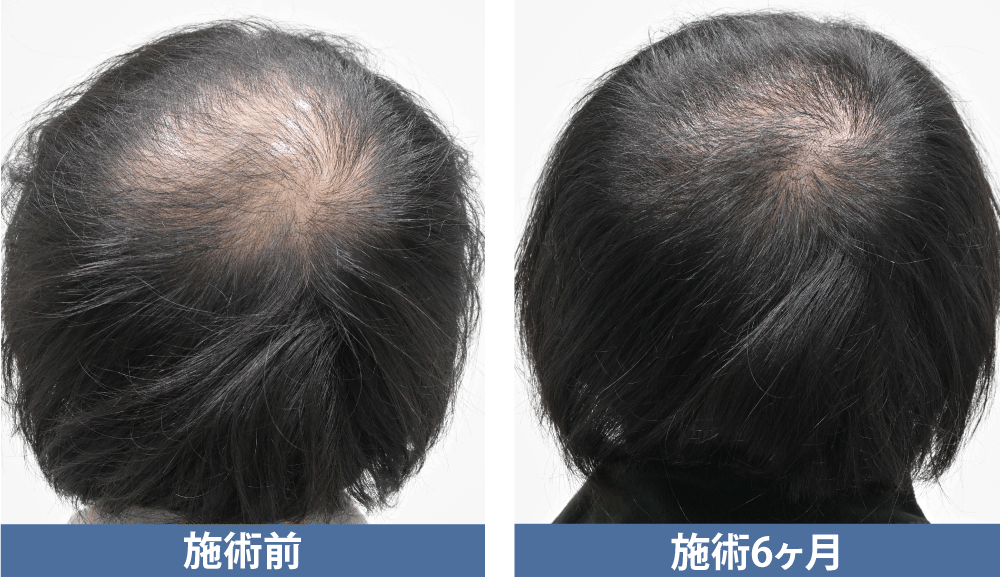 術後6ヶ月：まだ透け感が残る時期