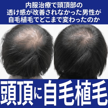 頭頂部植毛1500グラフトの経過ご紹介
