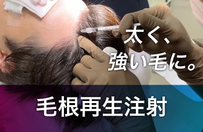 毛根再生注射