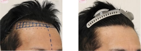AGA治療薬＋自毛植毛の症例写真 治療前と治療12ヶ月後の比較