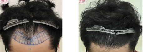AGA治療薬＋自毛植毛の症例写真 治療前と治療12ヶ月後の比較