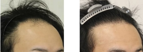 毛根再生注射＋自毛植毛＋AGA治療薬の症例写真 治療前と治療12ヶ月後の比較
