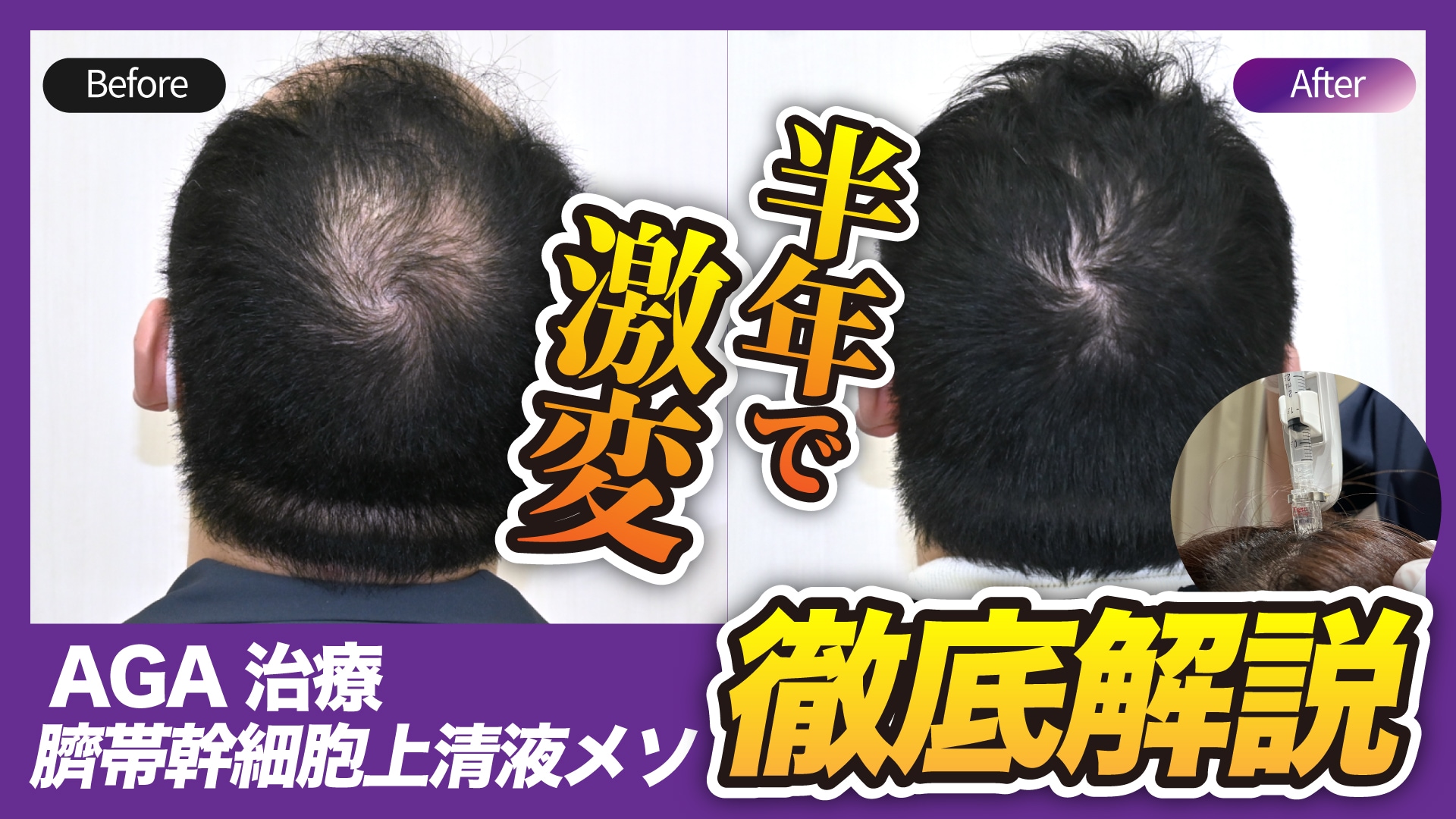 頭頂部の薄毛に「効果ない」と感じたら？AGA薬の次に試すべき『臍帯幹細胞上清液メソ』