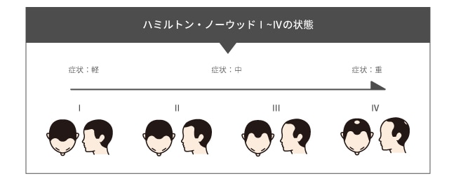 必要なグラフト数の目安はどのくらい?