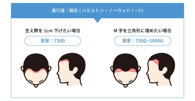 1. 軽度(ハミルトン・ノーウッドⅠ~Ⅱ)