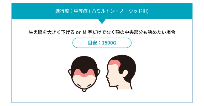 2. 中程度以上(ハミルトン・ノーウッドⅢ以上)