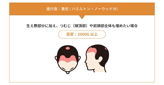3. 重度(ハミルトン・ノーウッドⅣ以上)