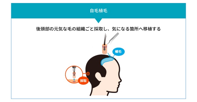 自毛植毛という選択肢